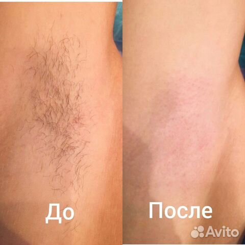 Шугаринг/депиляция