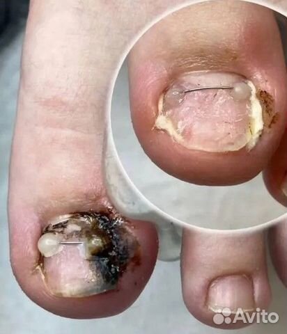 Медицинский педикюр вросший ноготь